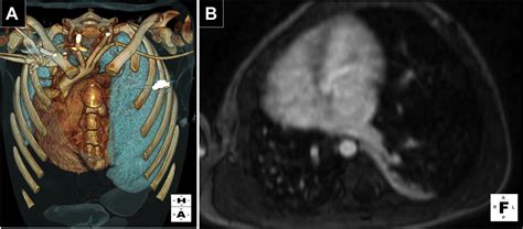 Multimodality Approach To A Complex Scimitar Syndrome How Advanced