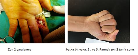 El Fleks R Tendon Yaralanmalari Prof Dr M Naz M Karalezli