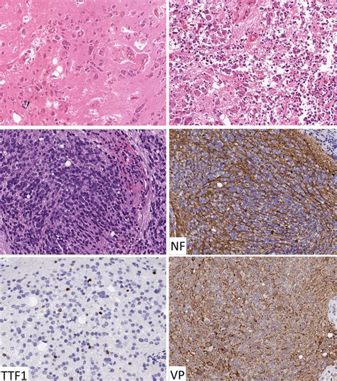 Hypothalamic Neuroendocrine Tumors Tumors Composed Of Hypothalamic