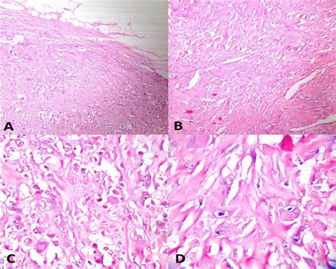 A Section Shows Tumor Which Is Well Circumscribed H And E X 40