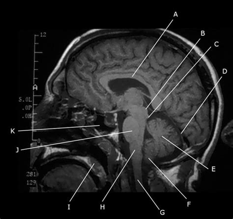 Brain Ct And Mri Sectional Anatomy Sagittal Flashcards Quizlet