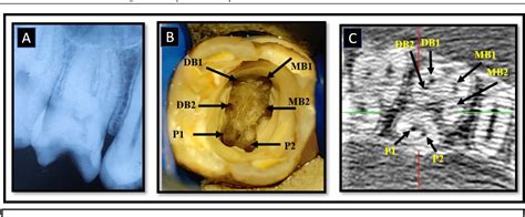 Figure 1 From Endodontic Management Of Maxillary First Molar With Three