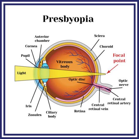 Presbyopia Ora Llc