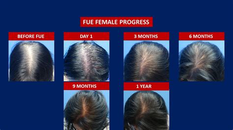 Fue Female Hair Transplant Hair Transplant Centre Malaysia