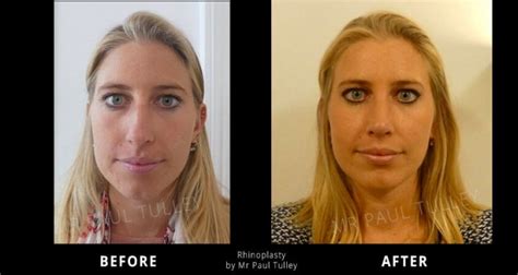 Rhinoplasty Gallery Rhinoplasty Before And Afters Paul Tulley