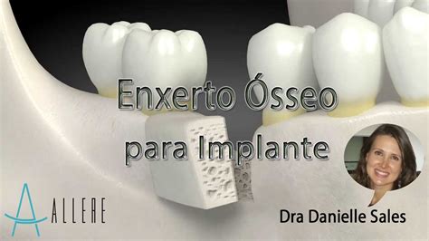 ENXERTO ÓSSEO PARA IMPLANTE DRA DANIELLE SALES clinicaallere