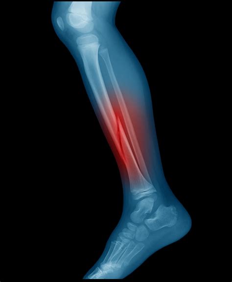 Adult Lower Leg Fracture