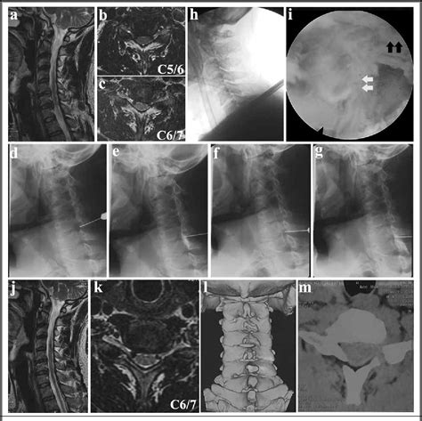 Figure 1 From Clinical Outcomes Of Posterior Percutaneous Endoscopic