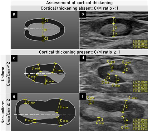 Terms Definitions And Measurements To Describe Sonographic Features Of