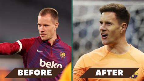 Ter Stegen's Inspiring Hair Transplant Story - SULE HAIR TRANSPLANT