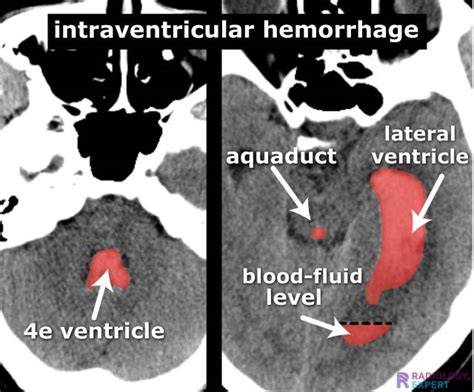 ct brain hemorrhage