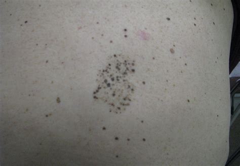 DermDx: Cluster of Pigmented Macules - Dermatology Advisor