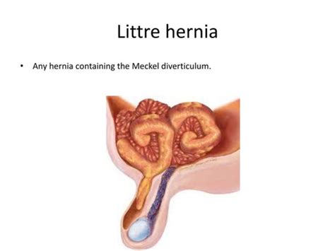 Hernias Flashcards Quizlet