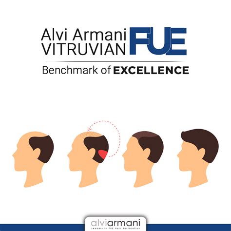 Alvi Armani Hair Transplants Have Achieved A Benchmark Level With The