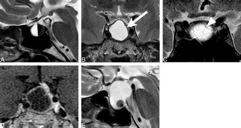 Figure 1 From Diagnostic Model Using Mri Adenomas And Rathke Cleft