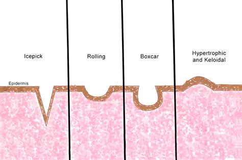 Comprehensive Guide To Understanding And Treating Acne Scars Types