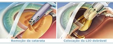 Cirurgia De Catarata Cl Nica Oftalmol Gica Sakata