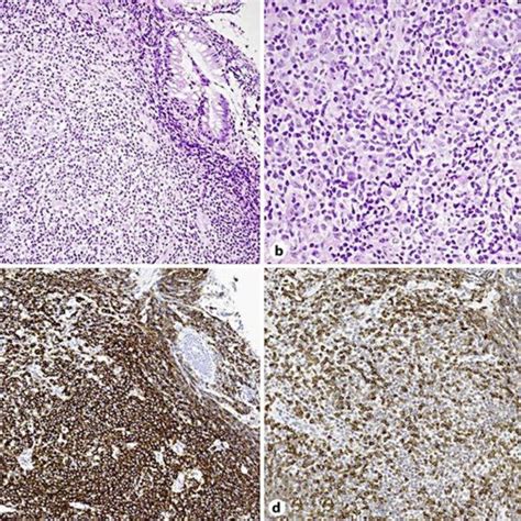 A Microscopic Findings Of A Rectal Biopsy Specimen Showed Diffuse