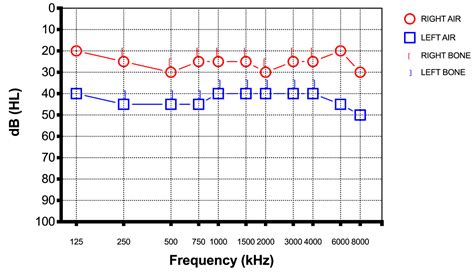 Sudden Sensorineural Hearing Loss