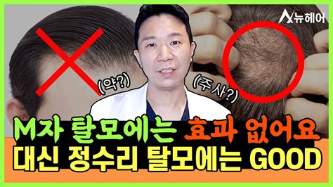 정수리 탈모치료 효과 보는 방법 알려드립니다ㅣ뉴헤어 Youtube