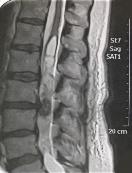 Cas Irm Lombaire En Coupe Sagittale En S Quence T Montrant L Sion