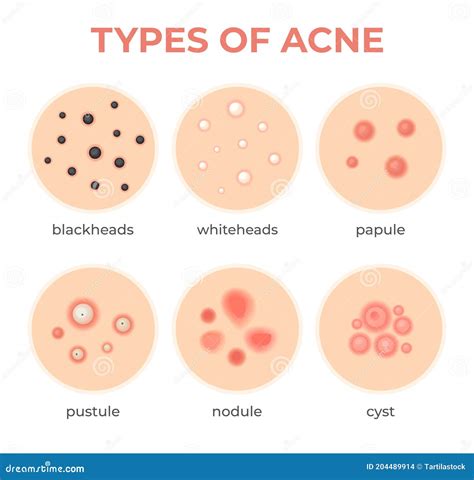 Acne Types Skin Infection Problem Pimples Grade And Type Cyst