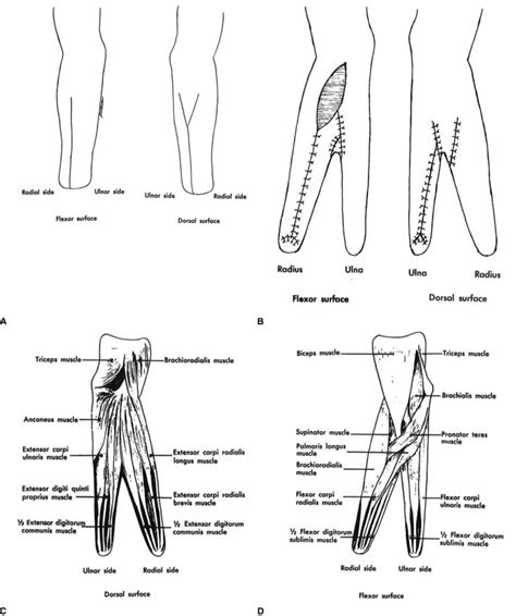 The Krukenberg Procedure; After the devastating amputation of a hand, a ...