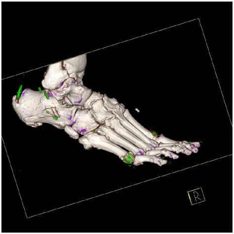 Dual Energy CT Of The Right Foot In A Patient With Tophaceous Gout