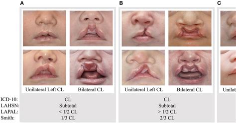 Cleft Lip And Palate