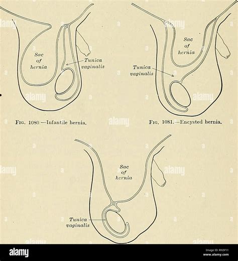 inguinal hernia  res stock photography  images alamy