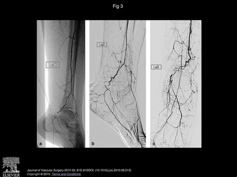 Frank Pomposelli Md Journal Of Vascular Surgery Ppt Download