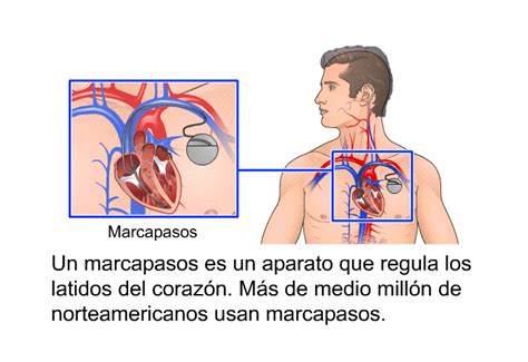 PatEdu Marcapasos