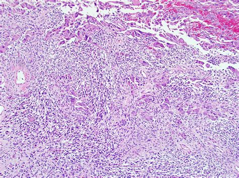 Pathology Outlines - Sarcomatoid