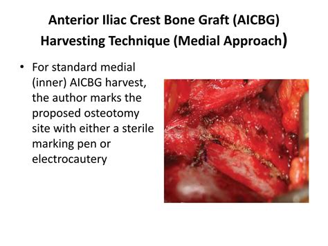 Anterior iliac crest | PPTX