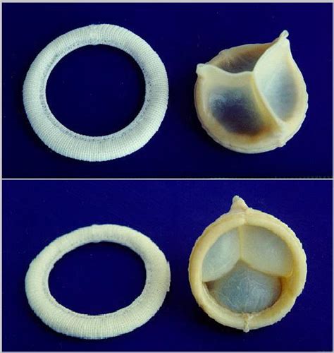 Aortic valve - wikidoc