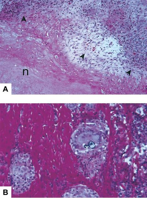 Figure 2 From Vertebral Osteomyelitis Due To Infection With