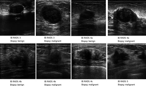 Malignant Breast Cancer On Ultrasound