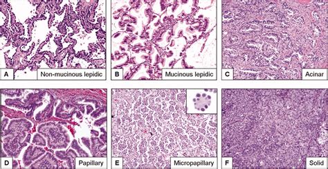 Histologic Patterns And Molecular Characteristics Of Lung