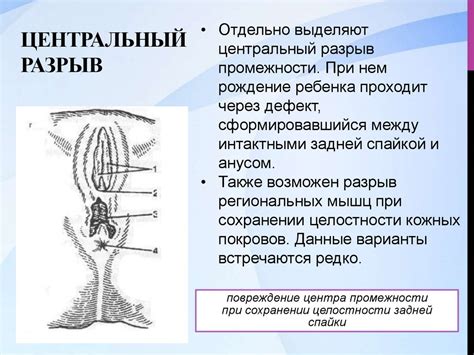 Разрывы промежности, оценка степени разрыва, методы восстановления ...