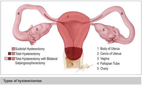 Hysterectomy Surgery Uterus Surgery Frisco Dallas Plano Tx