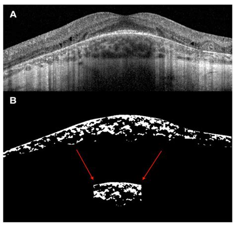 Diagnostics Free Full Text Choroidal Vascularity Features In Patients With Choroideremia And