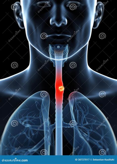 Esophagus cancer stock illustration. Illustration of inflamed - 30727017