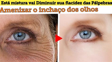 Como Amenizar Rugas Ao Redor Dos Olhos Sobre Os Olhos