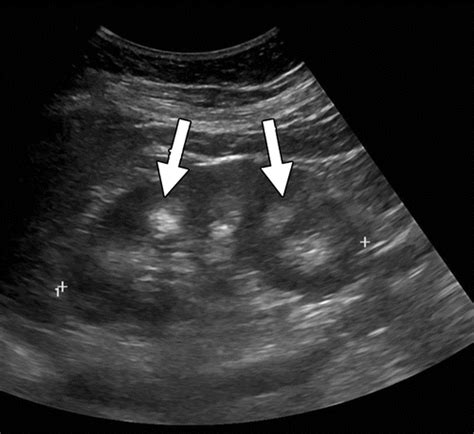 Diagnostic Approach To Benign And Malignant Calcifications In The