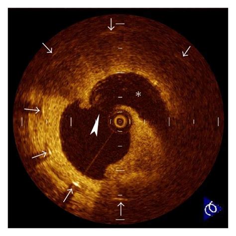 Neointimal plaque rupture. A 71-year-old male was admitted to our ...