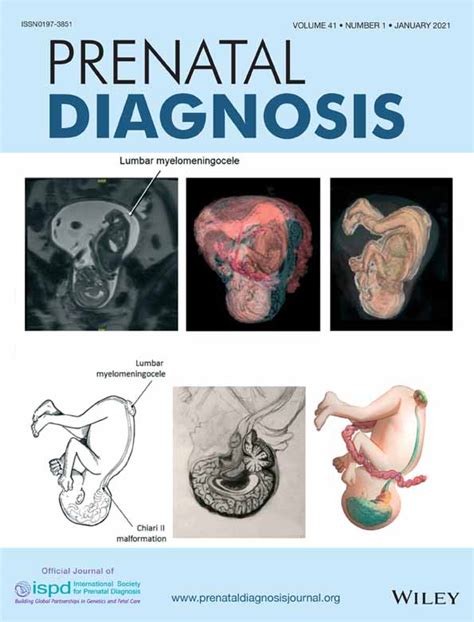 Selective Fetal Reduction In Complicated Monochorionic Twin Pregnancies