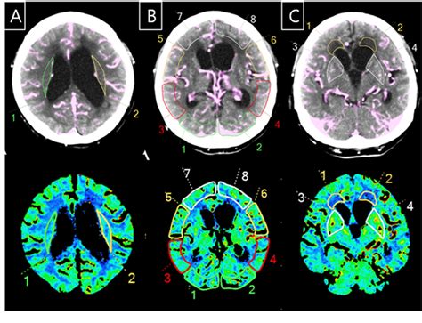 Figure 1 From Changes In Computed Tomography Perfusion Parameters And