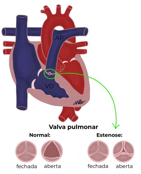 Estenose Pulmonar Adriana Mello