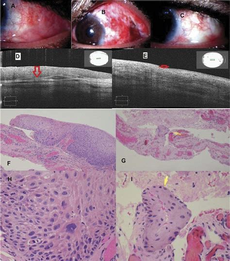 Figure 1 From As Oct Guided Treatment Of Diffuse Conjunctival Squamous Cell Carcinoma With