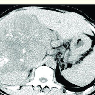 Computed Tomography Scans Of Total Abdomen Identifying Adrenal Mass